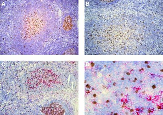 Fig. 1. Immunostaining of progressively transformed germinal centers for Ki67 and Ki67/CD38. / (A,B) PTGCs of patients 3 and 5 stained for Ki67 using peroxidase to detect binding. (C) Ki67 and CD38 double staining of a PTGC of patient 5. Ki67 was visualized using peroxidase and DAB as substrate (brown) and CD38 with alkaline phosphatase and Fast Red. (D) High-power magnification of panel C (40 ×).