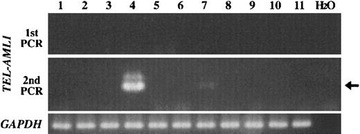 Fig. 7. TEL-AML1 fusion transcript in normal peripheral blood samples. / Representative results of nested RT-PCR for TEL-AML1 fusion transcript of normal peripheral blood samples. TEL exon 5 forward primers (TEL940f and TEL981f) and AML1 exon 4 reverse primers (AML1-r41 and AML1-r42) were used. H2O represents negative control. Arrow indicates positive band indicatingTEL-AML1 fusion transcript.