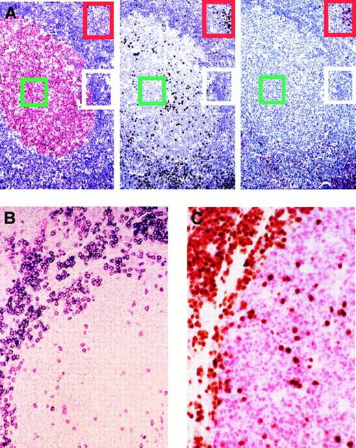 Fig. 1. Expression of BCL-6, MUM1, and CD138/syn-1 in reactive B cells identifies 3 major phenotypic patterns that correspond to physiologic stages of B-cell development. / A subset of germinal center B cells express MUM1 and are negative for CD138/syn-1 and BCL-6. (A) Serial sections from hyperplastic lymph node from an HIV-infected patient with persistent generalized lymphadenopathy (PGL). (Left) Within a follicle numerous germinal center (GC) cells (centroblasts and centrocytes) exhibit nuclear staining (red) for BCL-6, whereas B cells of the mantle and perifollicular areas score negative. (Center) In the same follicle, expression of MUM1 is restricted to a subset of cells located in the GC. Conversely, most MUM1+ cells are located in the perifollicular and interfollicular areas; brown staining is nuclear. (Right) In the same field, large cells with plasma cell morphology show strong cytoplasmic and membrane staining (red) with the anti–syn-1 mAb. They are present within the perifollicular and interfollicular areas in which MUM1+ cells are more numerous (compare figure on the right for syn-1 and figure in the center for MUM1). Conversely, syn-1 is absent in intrafollicular or extrafollicular cell populations other than plasma cells (see also panel B). Thus, the coordinated expression of BCL-6, MUM1, and syn-1 in reactive B cells shows 3 major phenotypic patterns corresponding to physiologic stages of B-cell differentiation—(1) centroblasts (the BCL-6+/MUM1−/syn-1− profile, identified by green squares; (2) late GC/early post-GC B cells (the BCL-6−/MUM1+/syn-1− profile, identified by white rectangles); (3) post-GC B cells (the BCL-6−/MUM1+/syn-1+ profile, identified by red rectangles). Paraffin-embedded tissue sections, APAAP (left and right), immunoperoxidase (center), hematoxylin counterstain. Original magnification, × 250. (B) With the exception of plasma cells, MUM1+ cells in the GC and in the perifollicular areas are negative for CD138/syn-1. Hyperplastic lymph node from an HIV-infected patient with PGL. Two-color staining. The figure shows a follicle with a large GC and a thin mantle zone. Numerous perifollicular cells and some scattered GC cells exhibit nuclear staining (red) for MUM1. Moreover, in the same field, a fraction of large cells exhibiting plasma cell morphology coexpresses syn-1 with a strong cytoplasmic and membrane staining (blue). Cells coexpressing MUM1 and syn-1 are numerous within the perifollicular zone but are rare within the GC. Paraffin-embedded tissue section, no counterstain. Original magnification, × 250. (C) Expression of MUM1 by GC B cells is mutually exclusive with the expression of BCL-6 by the same cell. Reactive tonsil from an HIV-infected patient with persistent generalized lymphadenopathy with 2-color staining. Within a follicle, numerous GC cells exhibit nuclear staining (red) for BCL-6. In the same GC, several cells show nuclear staining (brown) with the anti-MUM1 antibody. MUM1+ cells are also present around the GC. No coexpression of BCL-6 or MUM1 markers by the same GC cell is detectable. Paraffin-embedded tissue section, no counterstain. Original magnification, × 250.