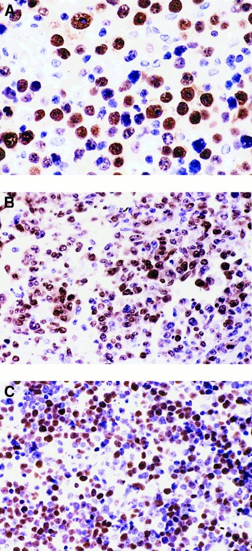 Fig. 2. Heterogeneous expression pattern of BCL-6 and MUM1 proteins throughout the pathologic spectrum of systemic AIDS-NHL. / (A) Systemic AIDS-IBL displaying the BCL-6−, MUM1+, syn-1+, CD10−, LMP1+ phenotype (case 38, Table 1). In the figure, most immunoblastic-plasmacytoid tumor cells show nuclear immunoreactivity with the anti-MUM1 antibody. (B) Systemic AIDS-DLCL, displaying the BCL-6+, MUM1+, syn-1−, CD10−, LMP1− phenotype (case 29, Table 1). In the figure, large tumor cells show a nuclear staining pattern with anti-MUM1 antibody. (C) Systemic AIDS-BL displaying the BCL-6+, MUM1−, syn-1−, CD10+, LMP1− phenotype (case 6, Table 1). Neoplastic cells display strong nuclear immunoreactivity with the anti–BCL-6 mAb. Paraffin-embedded tissue sections, immunoperoxidase (A, B, C), hematoxylin counterstain. Original magnification, × 400 (A), × 250 (B, C).