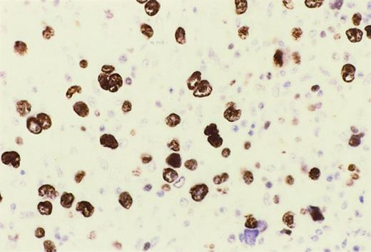 Fig. 3. Reed-Sternberg cells of HIV-HL express MUM1. / In a lymph node involved by lymphocyte depletion HIV-HL (case 16, Table4), MUM1 is expressed by a large number of tumor cells corresponding to RS cells and their variants. The staining is nuclear and intense. Immunoperoxidase, hematoxylin counterstain. Original magnification, × 250.