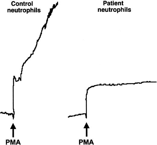 Fig. 2. The affected patient's neutrophils did not aggregate when stimulated. / Neutrophils (5.5 × 106 cells/mL) were stimulated in the cuvette of an aggregometer with fMLP (not shown) or PMA (10−7 M) at 37°C. Although the control neutrophils aggregated rapidly on addition of the agonist (arrow), the tracing from the cuvette containing the patient's neutrophils showed only the upward deflection caused by dilution.