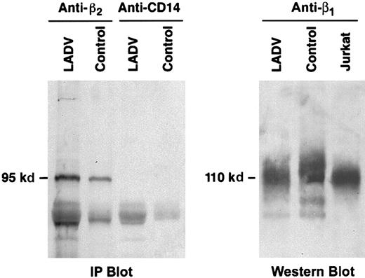 Fig. 9. The β1 and β2 proteins from LADV cells are of expected size. / (A) LADV cells and control lymphoblastoid cells were lysed and proteins in the lysates were immunoprecipitated with the anti-β2, mAb 60.3, or with an irrelevant control antibody, anti-CD14. The proteins were then separated on a 7.5% SDS-PAGE gel, transferred to a nitrocellulose membrane, and Western blot analysis was performed using the anti-β2 mAb 60.3. Equal amounts of protein were applied to each lane. The β2 protein band immunoprecipitated from LADV cells is of identical size and is at least as intense as that from control cells. (B) Transformed LADV cells, control lymphoblastoid cells, or Jurkat T cells were lysed, the proteins were separated on a 7.5% SDS-PAGE gel under nonreducing conditions, and analyzed by Western blot, using the anti-β1 mAb 13. Although there are variations in loading, the proteins from each cell type are of similar size.