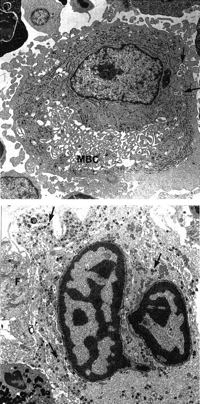 Fig. 2. Ultrastructural aspect of megakaryocytes. / (Top) A large mononucleated megakaryocyte with large membrane complex (MBC). Only few demarcation membranes are free (arrows). Magnification × 4750. (Bottom) Lytic mature megakaryocyte. The nucleus has the typical aspect of apoptotic cells with clumps of chromatin. The cytoplasm contains numerous granules (arrows). The cell membrane and intracytoplasmic membrane are lysed. A granulocytic peroxidase is present at the periphery. Note the presence of a fibroblast (F) closely associated to the lytic megakaryocyte. Magnification × 5320.