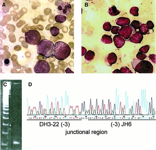 Fig. 1. Diagnosis of ALL secondary to CN. / Bone marrow smears at age 9 (A; severe congenital neutropenia before start of G-CSF treatment) and at age 13 (B; severe congenital neutropenia with secondary ALL). Heteroduplex PCR analysis (C) and characterization of rearranged immunoglobulin and T-cell receptor gene loci were performed as described earlier.5 Sequence analysis revealed a monoclonal rearrangement of the DH-JHtype (D). Figures in brackets indicate the number of flanking nucleotide deletions. Lowercase letters correspond to N-nucleotides.