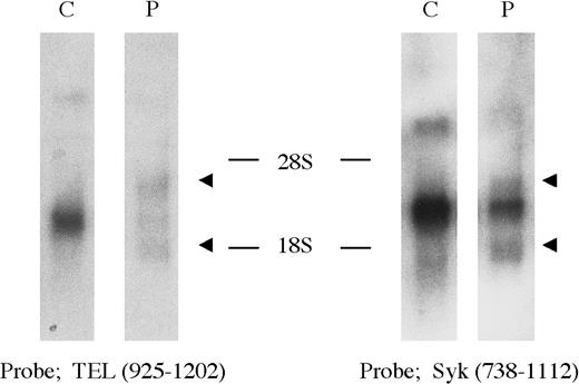 Fig. 3. Northern blot analysis of the TEL-Syk transcript. / The TEL probe T2, located 5′ of the translocation breakpoint, detected wild-type 6.5-, 4.5-, and 2.4-kb transcripts present in HL-60; novel 4.2- and 1.8-kb transcripts were identified in the patient's mononuclear cells with t(9;12). The Syk probe S, located 3′ of the translocation breakpoint, detected the same 4.2- and 1.8-kb transcripts in the patient's cells, whereas 5.6- and 2.8-kb transcripts were detected in HL-60.
