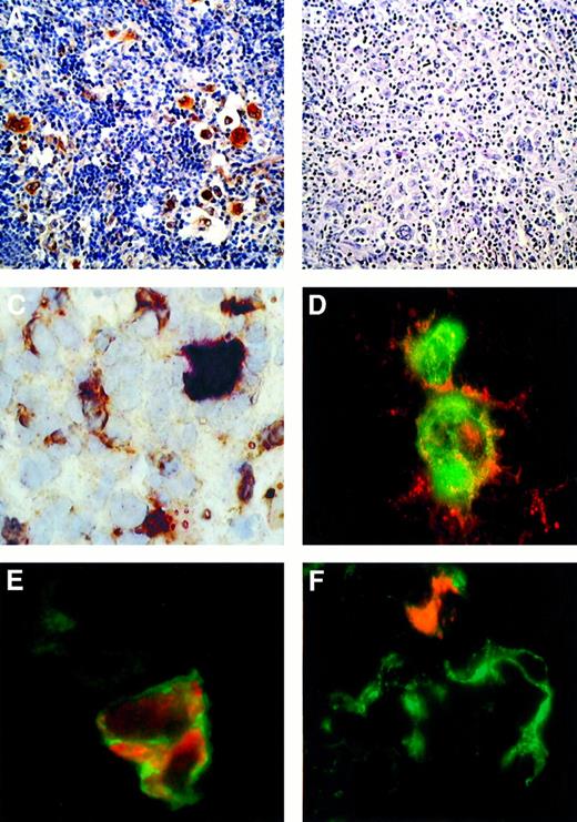 Fig. 1. c-MET and HGF expression in Hodgkin disease. / (A,B) HD, NS subtype in an immunocompetent patient. Immunohistochemical detection of c-MET with the C-28 rabbit pAb (A) and competitive inhibition with molar excess of blocking peptide relative to C-28 (SC-161) (B). (C) HD, NS subtype in an immunocompetent patient. A frozen section was tested by 2-color staining with the C-28 rabbit pAb and antihuman HGF goat antiserum. A c-MET+ RS cell showing strong cytoplasmic and nuclear staining in red is surrounded by several HGF+ cells (cytoplasmic reaction in brown). (D) Double-labeled immunofluorescence showing detection of c-MET (red fluorescence) and CD30 mAb (green fluorescence). CD30+ RS cells exhibit membranous and cytoplasmic c-MET immunoreactivity. Yellow areas indicate colocalized CD30 and c-MET immunoreactivity. (E) Double-labeled immunofluorescence showing detection of c-MET (red fluorescence) and α5β1 integrin (green fluorescence). C-MET+ RS cell shows a membranous α5β1 immunoreactivity. In the same field a c-MET− stromal cell displays a weak α5β1 expression. (F) Double-labeled immunofluorescent detection of HGF (red fluorescence) and CD21 (green fluorescence). In a cluster of CD21+ dendritic-reticulum cells, one element exhibits both CD21 and cytoplasmic HGF immunoreactivity. ABC-px immunostaining with hematoxylin counterstaining is shown in panels A and B (original magnification × 100), and the immunostaining in panels C-F is described above (original magnification × 630).