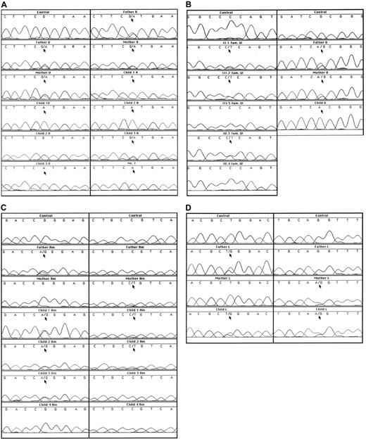 Fig. 1. Sequence analyses of genomic DNA. / (A) Results of a fragment around G757 in families V, A, and T. (B) Results of a fragment around C434 in family W and a fragment around G535 in family O. (C) Results of a fragment around G149 and a fragment around C194 in family Am. (D) Results of a fragment around T716 and a fragment around the intron 4/exon 5 boundary in family L.