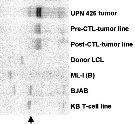 Fig. 1. The tumor lines have the same immunoglobulin VH rearrangement as tumor biopsy cells. / DNA was prepared from lung biopsy cells and from the spontaneous lines that grew from patient peripheral blood before and after CTL infusion. Controls were ML-1 and BJAB, which are B-cell lymphoma lines; the donor LCL; and a T-cell line KB (germline). DNAs were digested withBglII, separated on a 0.8% agarose gel, transferred to a nylon membrane, and probed with a JH probe. Identical bands in the pre- and post-CTL LCLs and the tumor biopsy cells shows that all 3 are derived from the same cell. The additional band in the tumor biopsy cells probably represents the germline immunoglobulin DNA (arrow) in non-B cells in the tumor tissue.
