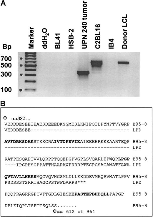Fig. 5. The tumor biopsy cells had a deletion in the EBNA-3B gene that removed the 2 immunodominant CTL epitopes. / (A) The tumor cells have a deletion in the EBNA-3B gene; 200 ng DNA from each of the indicated cell lines and from tumor biopsy cells taken 17 days after CTL infusion was amplified using primers that spanned the second to fourth HLA-A11–restricted epitopes in EBNA-3B. These were expected to generate a fragment of 593 base pairs in wild-type EBV. The products were run on a 2% agarose gel and stained with ethidium bromide. (B) Sequence of EBNA-3B deletion in the pre-CTL tumor line; 200 ng DNA from the pre-CTL tumor line and from BL41/B95-8 was amplified and sequenced using primers described by de Campos-Lima et al.35 This figure shows a comparison of a partial sequence of the EBNA-3B protein of B95-8 EBV, from amino acids 382 to 612 (of a total of 964 amino acids), with the same region of EBNA-3B from the patient-derived tumor cell line established prior to CTL infusion. HLA-A11–restricted epitopes are in bold.