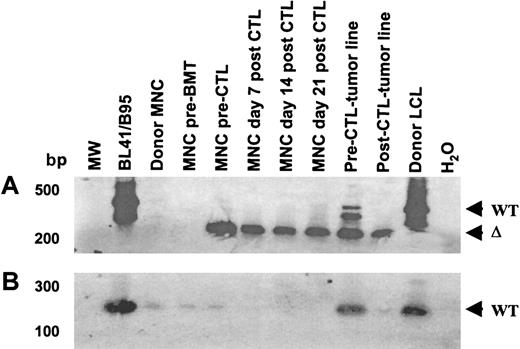 Fig. 6. The EBNA-3B deletion variant was evident prior to CTL infusion and persisted after CTL infusion, while virus with wild-type EBNA-3B was eliminated by CTL infusion. / (A) Primers spanning the EBNA-3B deletion were used to amplify viral DNA from patient and donor peripheral blood drawn before transplantation; from patient blood drawn prior to CTL infusion and 1, 2, and 3 weeks after CTL infusion; from the pre- and post-CTL tumor lines; and from the donor LCL. (B) Wild-type EBNA-3B was detected pre-BMT and pre-CTL but disappeared after CTL infusion. Primers from within the EBNA-3B deletion that could amplify only wild-type EBNA-3B DNA were used in an attempt to avoid competitive effects from the deletion template. The amplification products were run on a 2% agarose gel, Southern blotted, and probed with an EBNA-3B probe. The limitations of the sequence did not allow good PCR primers to be designed; nevertheless, faint wild-type EBNA-3B bands were seen in the donor LCL, donor and recipient mononuclear cells before BMT, and in recipient mononuclear cells pre-CTL infusion but not after. Wild-type EBNA-3B was also detectable in the pre-CTL tumor line and to a lesser degree in the post-CTL tumor line.