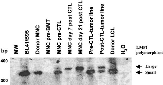 Fig. 7. Analysis of the LMP1 repeat revealed 2 viruses in the recipient before CTL infusion. / Primers spanning the LMP1 repeat region were used to amplify viral DNA. The amplification products were run on a 2% agarose gel, Southern blotted, and probed with an LMP1 complementary DNA probe. Two polymorphisms within the LMP1 repeat were detected prior to CTL infusion in the peripheral blood and the pre-CTL tumor line. After CTL infusion, the virus with the smaller repeat was not detectable in the peripheral blood, whereas the virus with the larger repeat persisted. In the post-CTL tumor line, the relative abundance of the virus with the smaller repeat was much reduced.
