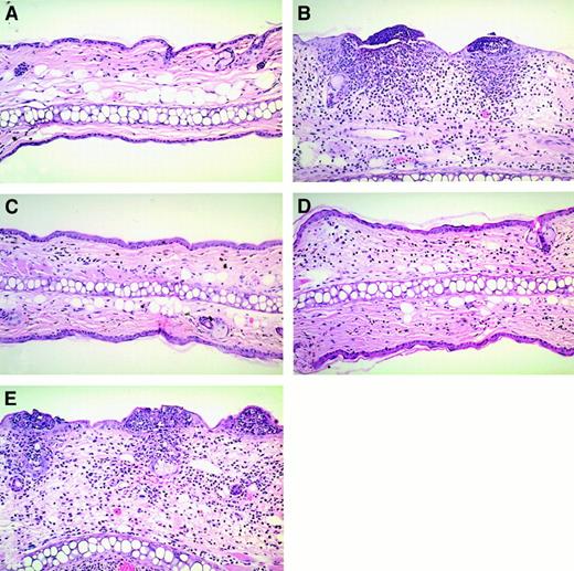 Fig. 4. Pathologic analysis of contact hypersensitivity. / Ears were harvested 24 hours after secondary oxazolone challenge. (A) Wild-type mouse, diluent only. (B) Sensitized wild-type mouse, hapten challenge. (C) Sensitized GM-CSF/IL-3–deficient mouse, hapten challenge. (D) Sensitized GM-CSF/IL-3–deficient mouse plus control treatment, hapten challenge. (E) Sensitized GM-CSF/IL-3-deficient mouse plus GM-CSF/IL-3 treatment, hapten challenge. All panels at ×200.