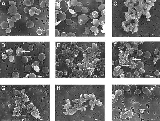 Fig. 6. SDF-1 and MDC induce bleb formation in platelets and cause microaggregation. / Washed platelets were subjected to SDF-1 or MDC at 0.5 μg/mL or to ADP under low-shear stresses for 10 seconds at 37°C, as described for Figure 2, and then fixed with glutaraldehyde for subsequent processing and examination by scanning electron microscopy.25 (A) Control. (B) Low ADP level (0.05 μM). (C) High ADP level (10 μM). (D) SDF-1. (E) MDC. (F) MDC–SDF-1 combination. (G) Low ADP and SDF-1. (H) Low ADP and MDC. (i) MDC. The white bar indicates 1 μm. The micrographs are representative of results with platelet preparations from 3 donors.