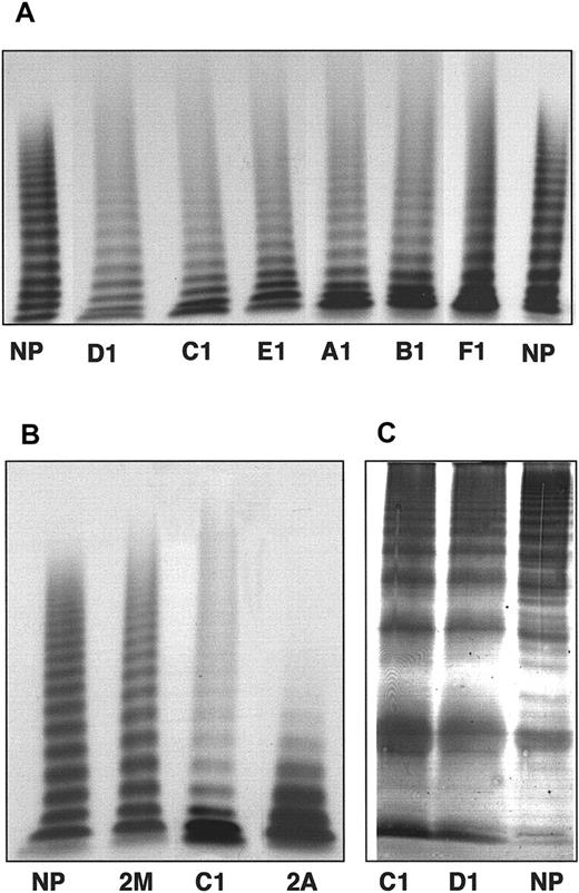 Fig. 1. Eight patients tested for multimeric analysis. / (A) Multimer analysis of plasma vWF from the propositus of each family. (B) Comparison of sample from the propositus C1 with type 2A (F751C) and type 2M (I662F) plasma vWF. The plasma samples were electrophoresed in 1% agarose gels and visualized using 125I-labeled anti-vWF pAbs. (C) Analysis of triplet structure of plasma vWF multimers. The samples from propositi C1 and D1 were electrophoresed in 2.5% agarose gels and visualized using anti-vWF pAbs labeled with alkaline phosphatase. NP indicates normal plasma.