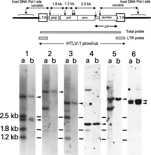Fig. 4. DNA blot analysis of the HTLV-I proviral genome in peripheral blood lymphocytes. / Ten micrograms cellular DNA was digested with PstI and subjected to standard Southern blot analysis. The filter was hybridized with a total HTLV-I probe (A) and then with an LTR probe (B). Arrowheads show the viral-cellular junction bands with LTR probe, in addition to 3 internal bands (2.5 kb, 1.8 kb, 1.2 kb). Schematic illustration of the HTLV-I genome, restriction map, and probes are shown on the upper column. (↓)PstI site. Lane 1: Typical patient with ATL showing 3 major internal bands (2.5 kb, 1.8 kb, 1.2 kb) with additional 2 viral-cellular junction bands (arrowheads). Lanes 2-5: Patients with ATL with deletion of internal bands, suggesting wide deletion in the HTLV-I virus (refer to the restriction map above).