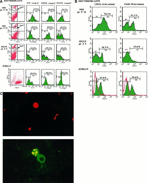Fig. 5. Evaluation of the apoptosis activation in bone marrow fresh erythroblasts. / (A) The cytofluorimetric analysis of the GpA+ population revealed a consistent presence of the proenzyme constitutive CPP32 and FLICE (caspases 3 and 8) in fresh erythroblasts from both MM patients with aggressive disease (no. 16 and 17) as compared with control MGUS patient no. 5, whereas ICE was only slightly represented. The measurement of these native proteases in Jurkat cells used as the control Fas+ cellular model confirmed their considerable expression in these cells. (B) Differential cytofluorimetric detection of CPP32-cleaved subunits in fresh erythroblasts from patients no. 16 and 5. The increment of both 12-kd and 89-kd (PARP) products in cells from patient no. 16 supported the previous activation of erythroblast apoptosis in vivo. A similar effect was detectable in Jurkat cells after their overnight incubation with the conditioned SN from myeloma cells of patient no. 16 containing high levels of Fas-L, as compared with untreated control cells (red). (C) Fluorescent pattern of erythroid apoptosis in bone marrow smears from patient no. 16. An erythroblast (top: PE positivity of glycophorin A) is juxtaposed (bottom) to a myeloma cell FITC+ for κ chains and is positive to the TUNEL assay (bottom) for the fluorescent condensation of the chromatin.