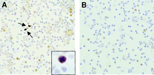 Fig. 3. EBER-RISH and CD20 staining of PBMNCs obtained from PTLD patient no. 1 and a healthy EBV+ donor. / (A) EBER-RISH shows numerous EBV+ B cells (indicated by arrows) in the peripheral blood of PTLD patient no. 1 at the period of the third PTLD diagnosis. Insert shows closeup of EBER and CD20+ cell. (B) In the healthy donor, there was no EBER signal detected, thereby confirming the low EBV loads in peripheral blood of healthy individuals.