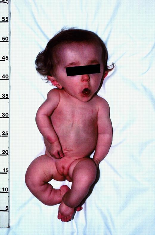 Fig. 1. Photograph of patient no. 1 illustrating the typical features of progressive deforming (type III) OI. / This 13-month-old girl has relative macrocephaly, triangular facies, and blue sclera (blocked by screen). Although not evident here, she also has malformed teeth, which is indicative of dentinogenesis imperfecta. Her extremities are shorter than normal, with mild curvature of the arms and marked angulation deformities of the lower legs. On roentgenograms (not shown), the bones appeared thin and osteopenic, with prominent curvatures not evident from physical examination. The humerus had an angulation of about 30°, and one of the lower legs was angulated approximately 100°. There was also evidence of old fractures. The thoracic cage was small, and the ribs were malformed. Published with parental consent.