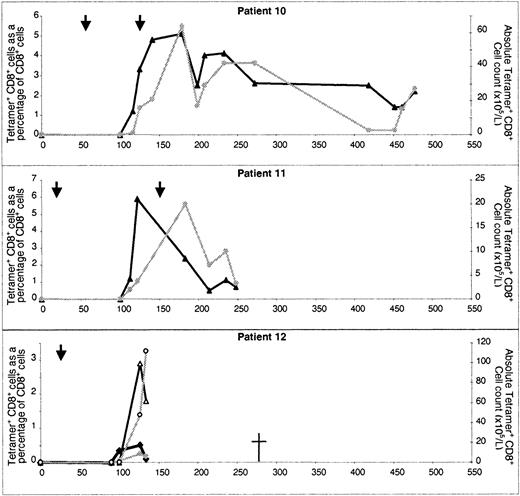 Fig. 3. Reconstitution of CMV-specific CTL in CMV-seropositive patients given transplants from CMV-seropositive MUDs. / Results in individual patients are shown. The number of days after transplantation is shown on the x-axis. The percentage of CD8+ T cells binding HLA-peptide tetramer (▴) and the absolute CMV-specific CTL count () are shown on the y-axes. In the graph for patient 12, the results for both the A*0201 tetramer (solid points) and the B*0702 tetramer (open points) are shown. Times of CMV reactivation are shown by arrows.