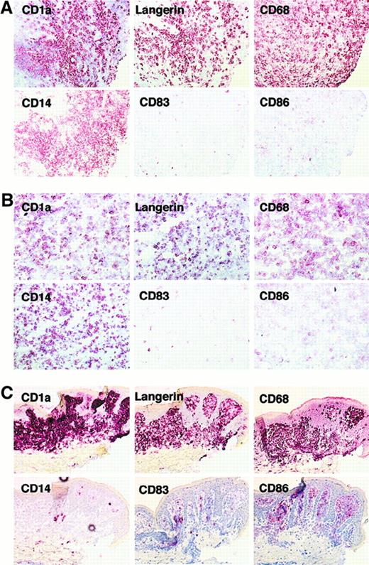 Fig. 1. Expression of CD1a, Langerin, CD68, CD14, CD83, and CD86 on LCH cells. / Serial sections from bone lesion of patient 10337 (eosinophilic granuloma) (A), lymph node from patient 6277 (multisystem disease) (B), and skin from patient 4968 (cutaneous histiocytosis) (C) were stained with CD1a, Langerin, CD68, CD14, CD86, and CD83. CD1a+cells from bone (A) and lymph node (B) lesions expressed Langerin, CD14, CD68, and did not express CD86 or CD83. CD1a+ skin lesion cells rarely expressed CD14 but expressed CD86 and some cells were also CD83+. Note that in bone and lymph node lesions CD68 and CD14 stained more cells than did CD1a and Langerin, but this was not the case in skin lesion.