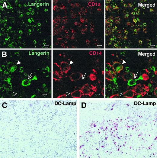 Fig. 2. CD1a+ Langerin+ cells may express CD14 but not DC-Lamp in eosinophilic granuloma. / (A, B) Frozen sections from eosinophilic granuloma of the bone (patient 7459) were fixed in acetone and stained with anti-Langerin FITC and either CD1a-PE (A), or CD14-PE (B) and analyzed by confocal microscopy. (A): antibodies against CD1a and Langerin labeled the same cells. (B): Langerin+CD14− (arrow), Langerin+, CD14+(closed arrowhead), and Langerin− CD14+ (open arrowhead) are observed. Similar results were obtained in 3 different patients. A representative experiment is shown. Bar represents 20 μM in panel A and 10 μM in panel B. (C, D) Sections from a bone lesion (C), and a skin lesion (D) were stained with anti–DC-Lamp antibody. Although numerous positive cells are seen in the skin lesion, they are very rare in the bone lesions. Similar results were obtained in 3 different patients in each group.