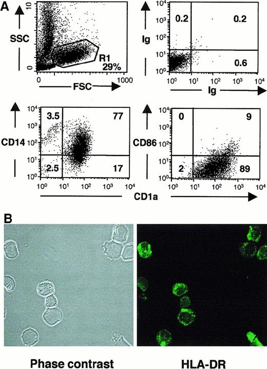 Fig. 3. LCH cells from eosinophilic granuloma coexpress CD1a and CD14 but not CD86 at the cell surface, and MHC class II within intracellular vesicular compartments. / (A) Fresh tissue from eosinophilic granuloma (patient 5149) was gently dissociated, and the cell suspension was washed 3 times and incubated with FITC-conjugated anti-CD1a and PE-conjugated CD14 or CD86, or with FITC and PE isotypic-matched controls. Dot plots represent the phenotype and percentages of labeled cells in the monocytic gate (R1, 29% of total events). Similar results were obtained in 2 other patients. (B) Confocal microscopy analysis of CD1a+ cells sorted from eosinophilic granuloma stained with FITC-conjugated anti–HLA-DR. Note the vesicular, intracytoplasmic staining.