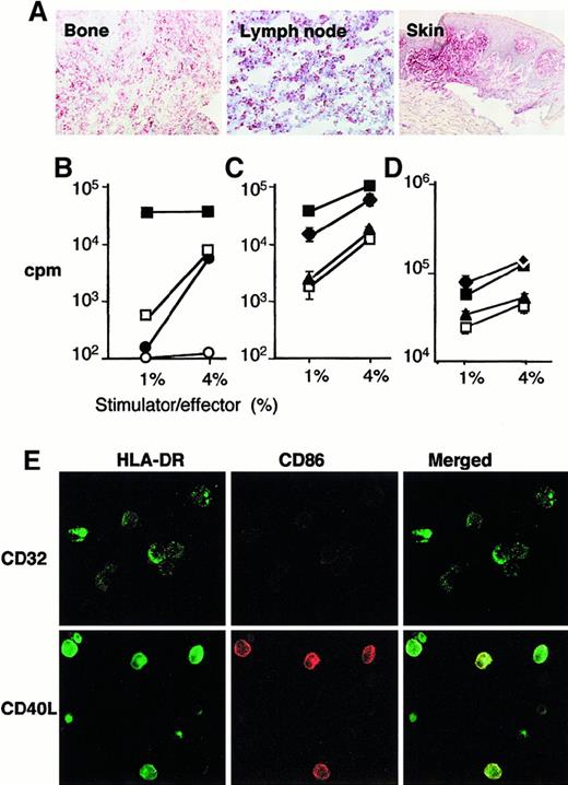 Fig. 4. LCH cells from eosinophilic granuloma are immature DCs but may be induced to express membrane class II and C86 and to stimulate allogenous lymphocytes on stimulation with CD40L. / (A) Sections from bone lesion of patient 10337 (eosinophilic granuloma), lymph node from patient 6277 (multisystem disease), and skin from patient 4968 (cutaneous histiocytosis) were stained with antibody to CD40. (B) Control immature (□) and mature (■) (CD40L treated) monocyte-derived DCs and CD1a+ (●) and CD1a− (○) cells sorted from fresh eosinophilic granuloma tissue from patient 7459 were cultured with 105 allogenous lymphocytes at 1% or 4% stimulator to effector ratio. (C) sorted CD1a+ cells from eosinophilic granuloma from patient 10391 (▴, ⧫) and control monocyte-derived DC (□, ■) were either cultured with LcCD32 (▴, □) or with LcCD40L (⧫, ■) for 2 days, and then cultured with 105 allogenous lymphocytes at 1% or 4% stimulator to effector ratio. Note that LCH CD1a+cells, either fresh or cultured with LcCD32 stimulate T-cell proliferation in a similar manner to that of control immature monocyte-derived DCs, whereas LCH CD1a+ cells cultured with LcCD40L stimulate T-cell proliferation in a similar manner to that of control mature monocyte-derived DCs cultured with LcCD40L. (D) The same experiment was performed with fresh tissue from eosinophilic granuloma from patient 3774. (E) Sorted CD1a+ cells from eosinophilic granuloma from patient 10391 cultured with LcCD32 or with LcCD40L for 2 days were also analyzed by confocal microscopy for expression of HLA-DR (green) and CD86 (red). Note that green DR staining increased and is present at the cell surface, in cells cultured with LcCD40L, and that red CD86 staining, absent on cells cultured with LcCD32, is induced on cells cultured with LcCD40L.