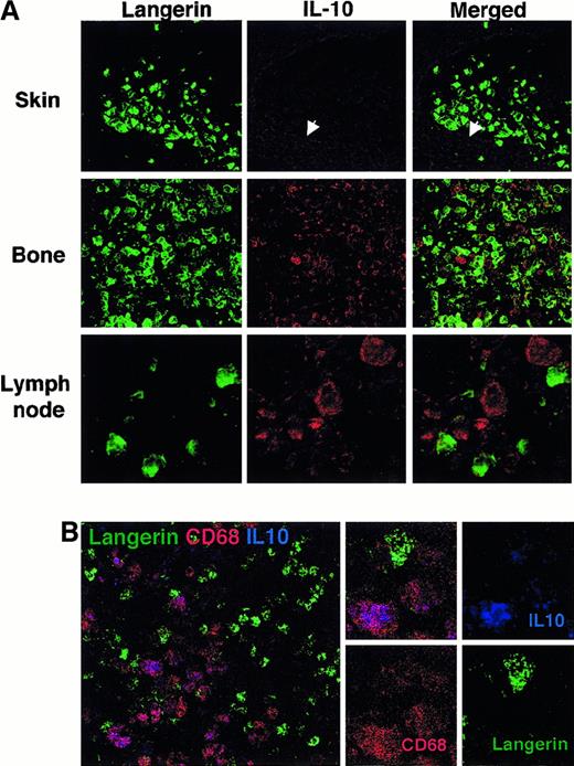 Fig. 5. Presence of IL-10–expressing macrophages in the vicinity of LCH cells in bone and lymph node lesions but not in isolated skin lesions. / (A) Frozen sections from skin lesion (patient 6423), eosinophilic granuloma of the bone (patient 7553), and a lesional lymph node (patient 6193) were fixed in acetone and stained with anti-Langerin (mouse IgG1) revealed with a goat F(ab)2 antimouse IgG and with anti–IL-10 (rat IgG) and streptavidin-Cy3 and examined by confocal microscopy. Only faint background staining with anti–IL-10 was detectable in the epidermis (arrow) and dermis of the skin lesion (upper panel, magnification × 40). Similar results were observed in 3 patients with isolated skin disease. At the same magnification, relatively numerous cells stained with anti–IL-10 were readily detectable (in red) within eosinophilic granuloma (middle panel). Although faint IL-10 staining may be observed in some Langerin-stained cells, most frequently, IL-10 and Langerin staining did not colocalize. Similar results were observed in 3 patients with bone disease. A similar pattern is also observed in lymph node section (lower panel), shown at a higher magnification (× 100) to illustrate that Langerin positive cells display virtually no staining for IL-10, whereas the Langerin− large-sized cells in their close vicinity strongly express IL-10. (B) Frozen sections from eosinophilic granuloma of the bone (patient 10337) were stained with FITC-conjugated anti-Langerin (DCGM-5, mouse IgG1), PE-conjugated CD68 (Pharmingen) and with anti–IL-10 (rat IgG) and streptavidin-Cy5 and examined by confocal microscopy. Cells that stained strongly for IL-10 (blue) also stained strongly for CD68 (red) and appeared purple, whereas Langerin-stained cells (green) display weaker CD68 expression and no or very weak IL-10 staining.