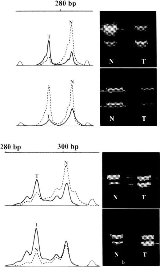 Fig. 7. Examples of raw data. / On the right hand side of each panel are virtual images of fluorescent bands from the gel. Those from the granulocytes are marked N and those from the T cells are marked T. On the left hand side of the panel are shown the intensities of the corresponding bands on a vertical scale plotted against molecular weight in base pairs (bp) on the horizontal scale. Those from granulocytes are marked in interrupted lines and those from T cells in solid lines. In the lower part of the diagram is shown an example of skewed X inactivation in granulocytes but the drift from that in the T cells is similar in each of the monozygotic twin pairs, which is probably due to genetic selection of one chromosome over the other. In the upper part of the diagram are shown data from one of 2 individuals with skewed X inactivation compared to both their T cells and cognate twin (also shown), which is difficult to explain with a selective mechanism.