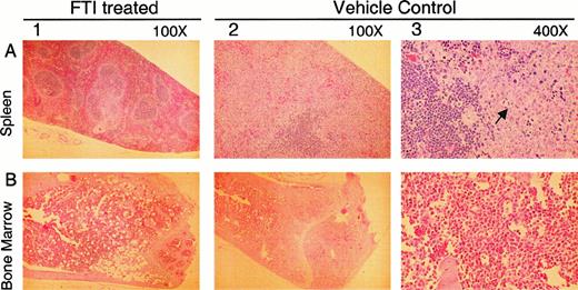 Fig. 7. Histology of treated and diseased mice. / Histopathologic analysis of bone marrow and spleen of mice injected with 106 BCR/ABL-BaF3 cells and treated with either SCH66336 (column 1) or vehicle alone (columns 2 and 3). Arrow represents site of infiltration with lymphoblasts. Magnification of photomicrographs is indicated.