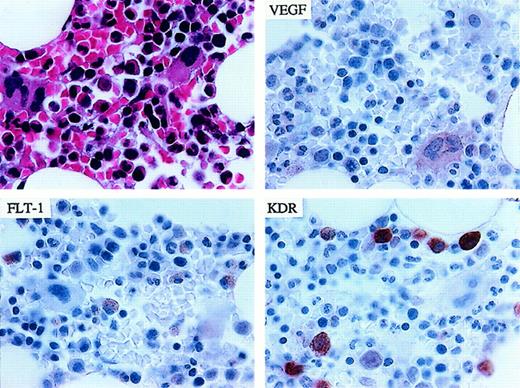 Fig. 1. Representative pattern of immunohistochemical staining of normal marrow for VEGF, FLT-1/VEGFR-1, and KDR/VEGFR-2. / (upper left) Hematoxylin and eosin staining. (upper right) Faint VEGF signal in megakaryocytes, monocytes, and occasional myelocytes. (lower left) Low-intensity Flt-1/VEGFR-1 signal in macrophages–histiocytes and rare myeloid elements. (lower right) Strong KDR/VEGFR-2 staining in scattered histiocytes (1000 × magnification).