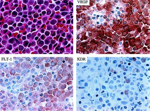 Fig. 2. Demonstration of co-expression of VEGF and Flt-1 in neoplastic myelomonocytic leukemia cells in a patient with CMML. / (upper left) Hematoxylin and eosin staining. (upper right) IHC for VEGF demonstrating strong protein expression. (lower left) Same patient demonstrating co-expression of the Flt-1/VEGFR-1 receptor. (lower right) Rare KDR/VEGFR-2 positive cells were observed (1000 × magnification).