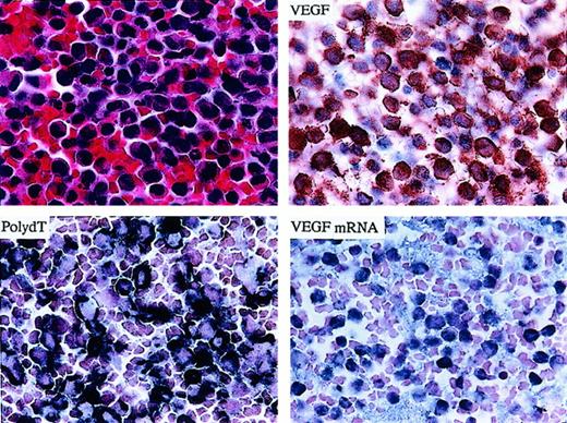 Fig. 3. Demonstration of abundant VEGF mRNA and protein signals in neoplastic myelomonocytic leukemia cells (CMML). / (upper left) Hematoxylin and eosin staining. (upper right) IHC demonstrating strong VEGF protein expression. (lower left) Poly d(T) staining confirming integrity of total mRNA. (lower right) ISH demonstrating strong expression of the VEGF message in a patient with CMML (1000 × magnification).