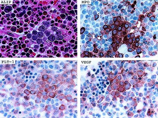 Fig. 4. Co-expression of VEGF, Flt-1/VEGFR-1, and myeloperoxidase in a cluster of leukemic blasts (ALIP) in a patient with RAEB. / (upper left) Hematoxylin and eosin staining demonstrating a cluster of ALIP. (upper right) IHC staining for myeloperoxidase (MPO) demonstrating strong expression in ALIP clusters. (lower left) IHC staining demonstrating expression of the Flt-1/VEGFR-1 receptor in a cluster of ALIP cells. (lower right) IHC demonstration of co-expression of VEGF protein in the same cluster of ALIP cells (1000 × magnification).