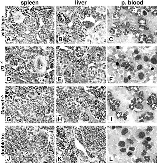 Fig. 3. Comparison of the histopathology of CML-like disease in different cytokine-deficient backgrounds. / Photomicrographs of hematoxylin/eosin-stained sections (magnification × 100) of spleen (A,D,G,J) and liver (B,E,H,K), and Wright/Giemsa-stained smears (magnification × 400) of peripheral blood (C,F,I,L), from mice with BCR/ABL-induced myeloproliferative disease where donor and recipient were of wild-type (A-C), Il-3−/− (D-F),Gm-csf−/− (G-I), and double-knockout (J-L) genotypes. Spleens demonstrate complete disruption of follicular architecture by infiltrating myeloid cells, erythropoiesis, and megakaryocytosis. Livers exhibit sinusoidal infiltration with maturing neutrophils, extramedullary erythropoiesis, and periportal collections of macrophages. Peripheral blood of mostIl-3−/− and some double-knockout recipients of like marrow displayed a predominance of monocytes and macrophages rather than neutrophils.