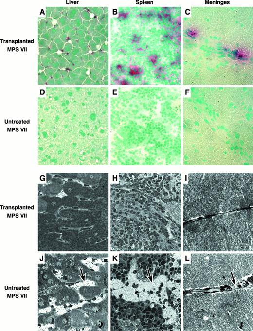 Fig. 4. Histologic analysis of transplanted and untreated control MPS VII mice. / (A-F) Frozen tissue sections stained with naphthol AS-BI β-d-glucuronide and counterstained with methyl green. Donor-derived pink/red GUS+ cells can easily be seen in the tissues of the transplant recipients. (G-L) Microscopic analysis of fixed tissues showing the reduction in lysosomal GAG storage. Tissues from the transplant recipients have reduced amounts of distended lysosomal “foamy” structures as compared to the untreated controls (see arrows).