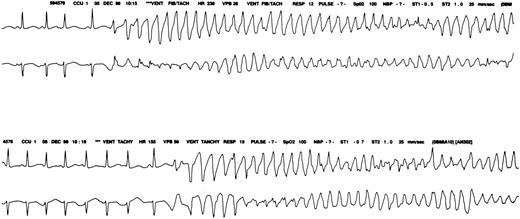 Fig. 1. Monitor strip. / Cardiac monitor strip shows torsades de pointes in patient 2.