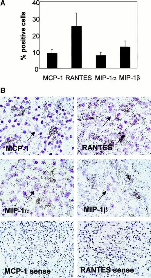 Fig. 1. Chemokine gene expression in HD lymph nodes. / (A) Percentage of cells expressing RANTES, MCP-1, MIP-1α, and MIP-1β. Results represent the mean (± SE) from 19 cases hybridized with specific antisense probes and evaluated quantitatively. (B) Representative in situ gene expression left: All the chemokines are expressed in the nonneoplastic leukocytic infiltrates of HD but not in H-RS cells (arrows). The sense probe controls for MCP-1 and RANTES are shown. The sense probe controls for MIP-1α and MIP-1β were comparable (data not shown).