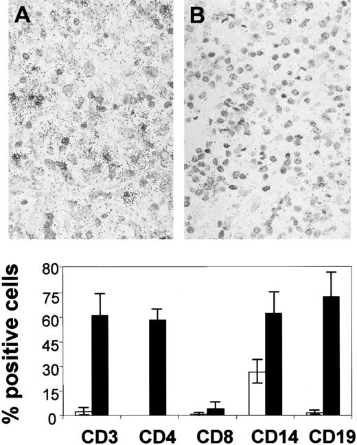 Fig. 4. CCR5 gene expression. / Top: In situ mRNA expression of CCR5 in a lymph node involved by HD. Hybridizations with antisense (A) and sense (B) probes are shown. Bottom: CCR5 expression in isolated cells sorted from control (■) and HD lymph nodes (▪). The figure represents the mean percentage (SE) of 3 distinct experiments.