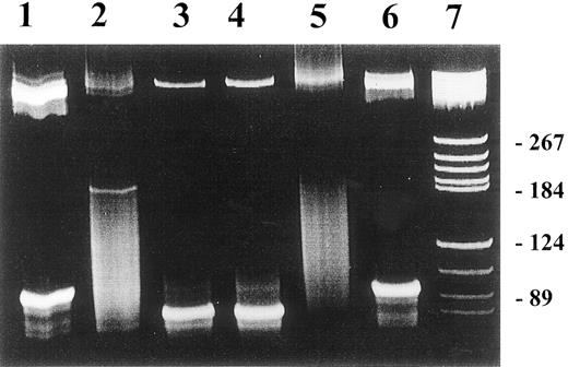 Fig. 1. The effect of antiviral treatment on immunoglobulin heavy-chain gene rearrangement in patients with chronic HCV infection. / Detection of IgH rearrangement was performed by FW3/JH seminested PCR in PBMCs from patients with HCV-infected individuals. Lanes 1 and 3: pretreatment bands represent the presence of IgH rearrangement; lane 2: disappearance of the band, indicating the loss of the proliferating B-cell clone upon completion of antiviral therapy. The patient had virologic response with clearance of HCV RNA at the end of treatment. Lane 4: persistence of the proliferative B-cell clone at the end of antiviral treatment. This patient had no virologic response. Lane 5: negative control; lane 6: positive control; lane 7: molecular weight marker. PCR products were separated on 2.5% agarose gel.