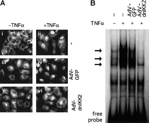 Fig. 2. Activation of NF-κB is inhibited in dnIKK2-expressing cells. / (A) Nuclear translocation of p65–NF-κB. Control HUVECs (i-ii) or HUVECs that had been transduced with control virus (iii-iv) or AdV-dnIKK2 (v-vi) were stimulated with TNFα for 1 hour (ii,iv,vi) or left unstimulated (i,iii,v). Nuclear translocation of NF-κB was revealed by immunofluorescence, using an anti-p65 antibody. (B) Nuclear extracts were prepared from control cells, AdV-GFP, and from AdV-dnIKK2–transduced HUVECs and were analyzed by electrophoretic mobility shift assay. The NF-κB–specific bands are indicated by arrows.