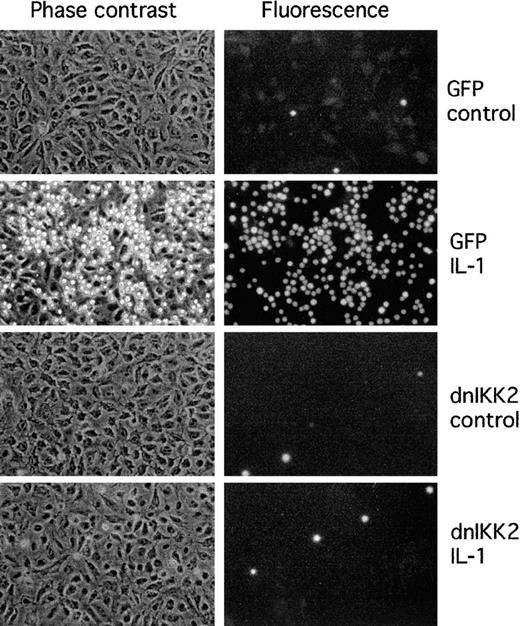 Fig. 5. Adhesion of HL-60 cells to HUVECs is inhibited by expression of dnIKK2. / HUVECs were transduced with AdV-dnIKK2 (dnIKK2) or control virus (GFP) as indicated and 3 days later stimulated with IL-1 for 4 hours. Adhered CMFDA-labeled HL-60 cells were viewed in phase contrast (left row) and under the fluorescence microscope in the FITC channel (right row).