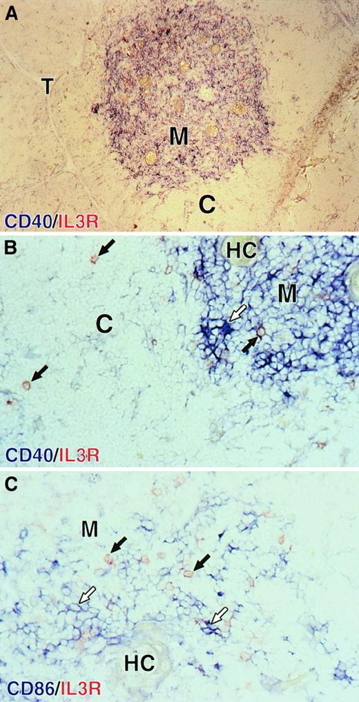 Fig. 7. Localization of plasmacytoid cells and DCs in the human thymus. / Plasmacytoid cells are both in the cortex and the medulla; mature DCs are localized in the thymic medulla. (A) Mature DCs expressing high levels of CD40 (in blue) are localized in the medulla (M) identified by the presence of Hassall corpuscles (HCs). (B) A closer view of the corticomedullary junction shows that round red IL-3Rα+plasmacytoid cells (black arrows) are found in the cortex and are found in the medulla near blue dendritic CD40highmature DCs (empty arrows). (C) In the medulla, blue CD86high DCs (empty arrows) are surrounded by red IL-3Rα+ plasmacytoid cells (black arrows). No blue CD86high DCs was found to coexpress the IL-3Rα. M indicates medulla; C, cortex; T, trabeculae; HC, Hassall corpuscles. Original magnification: 100 × (panel A); 400 × (panels B and C).