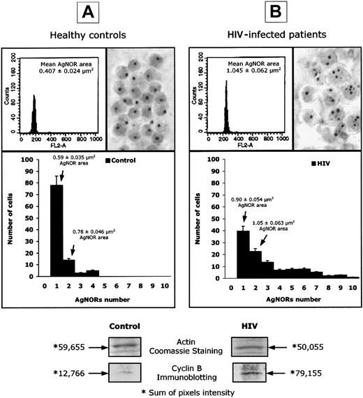 Fig. 1. Abnormal expression of AgNORs and cyclin B1 in lymphocytes from HIV-infected patients. / DNA content, assessed by PI staining, AgNOR number and area of distribution, and cyclin B1 intracellular concentration, expressed as pixel intensity of protein bands isolated by Western blot, in selected experiments performed on peripheral blood lymphocytes isolated from healthy controls (panel A) and HIV-infected patients (panel B). The numeric results represent the mean of 20 patients and 20 uninfected controls.