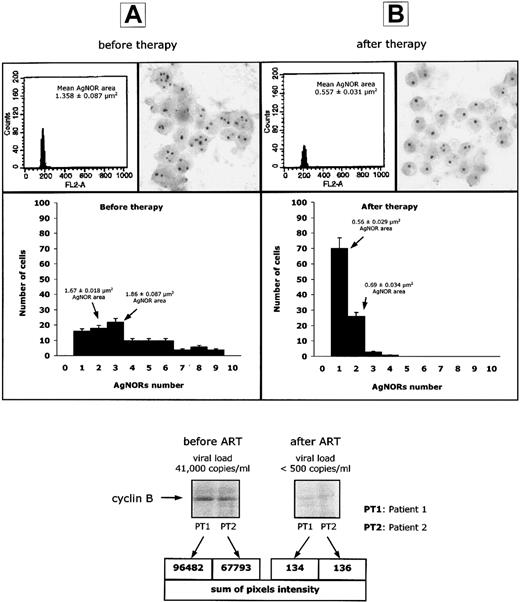 Fig. 2. Normalization of AgNORs and cyclin B1 expression after ART. / DNA content, AgNOR number and area of AgNOR distribution, and cyclin B1 intracellular concentration in selected experiments performed on peripheral blood lymphocytes isolated from 12 HIV-infected patients, before (panel A) and 15 to 21 days after (panel B) initiation of antiretroviral therapy.
