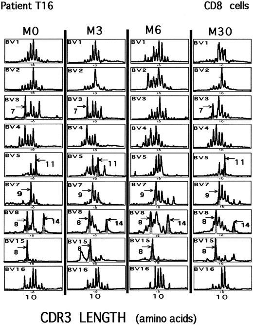 Fig. 1. Repertoire analysis in a patient with a partial response to HAART. / CD8+ PBMCs were studied for a 30-month period (M0 to M30) for patient T16. Viral replication was never completely suppressed during that period of analysis. Gray areas represent significant CD8 clonal expansions (see “Patients, materials, and methods”) found at M0 that remained present 30 months later. The CDR3 length of the major size peaks detected is indicated (arrow and number of amino acid residues). Graphs represent the intensity of fluorescence in arbitrary units, as a function of the CDR3 length, in amino acids of BV-BC single-strand DNA runoff products. Windows of analysis are centered on expected sizes corresponding to TCR transcripts encoding a 10-residue-long CDR3 region.