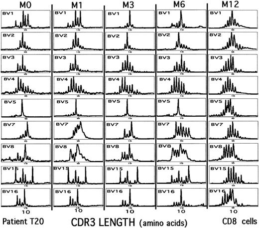 Fig. 3. Repertoire analysis in a good responder to HAART. / CD8+ PBMCs were sampled over a 12-month period of antiviral treatment for patient T20 that resulted in efficient suppression of HIV replication. Sample M0 was taken just before the onset of treatment. Note the normalization of the CD8 repertoire at M12.