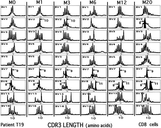 Fig. 5. Repertoire analysis in a patient with viral relapse. / Longitudinal repertoire analysis of CD8+ PBMCs for patient T19. Treatment with the HIV protease inhibitor was interrupted after M6, and a viral rebound occurred. Between M0 and M20, a clear shift in repertoire usage is observed. Gray areas represent CD8 clonal expansions present at the onset of treatment. Black areas represent new dominant clonal expansions (not every overrepresented peak size is shaded; Figure 2 shows the count of the latter).