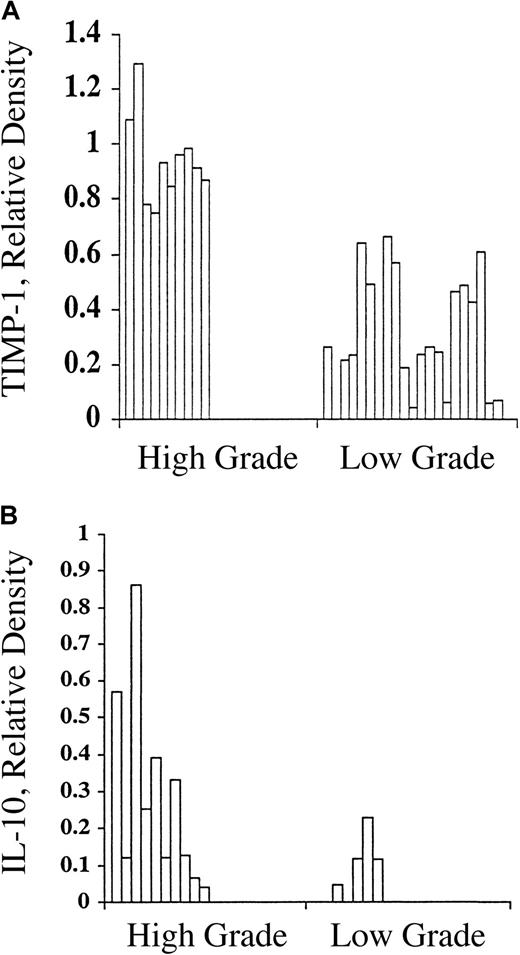 Fig. 5. TIMP-1 and IL-10 expression in B-cell non-Hodgkin lymphoma. / (A) Correlation of TIMP-1 expression, by RT-PCR, with histologic grade in B-cell non-Hodgkin lymphoma. Y-axis: relative density of TIMP-1 versus beta actin bands. A significant difference is noted between high- and low-grade tumors (P < .00001). (B) Correlation of IL-10 expression, by RT-PCR, with histologic grade in B-cell non-Hodgkin lymphoma. Y-axis: relative density of IL-10 versus beta actin bands. A significant difference is noted between high- and low-grade tumors (P < .00001).